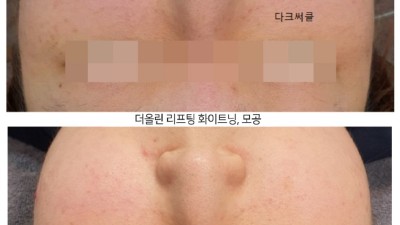 더올린 리프팅 전 후