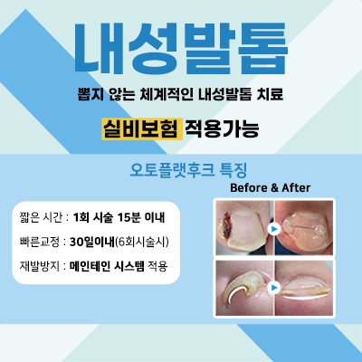 내성발톱치료