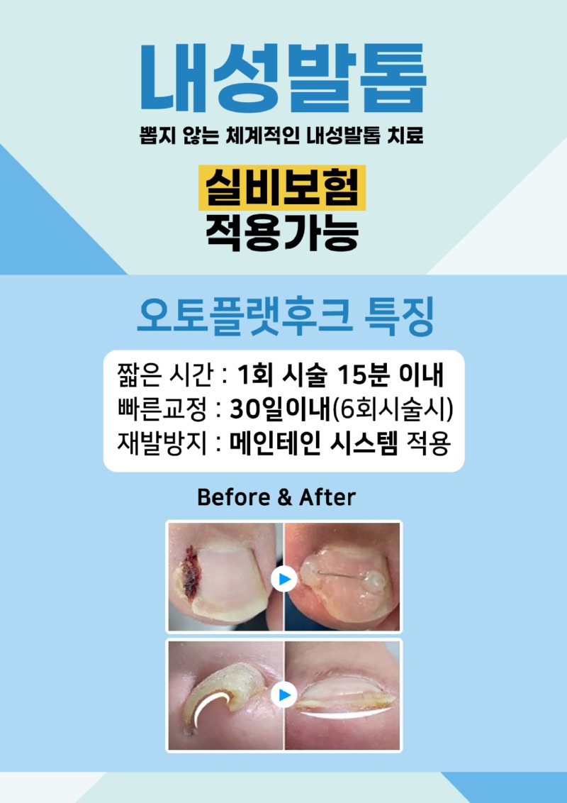 내성발톱치료.jpg