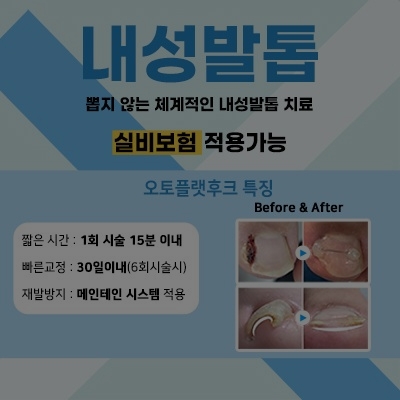 [종료] 내성발톱치료